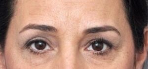 Brow Lift - Case 2654 - Before