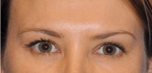 Brow Lift - Case 2658 - Before