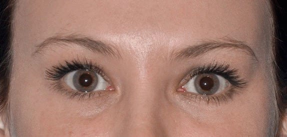 Brow Lift Patient Photo - Case 2658 - after view
