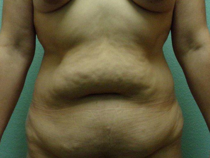 Tummy Tuck Patient Photo - Case 3606 - before view-