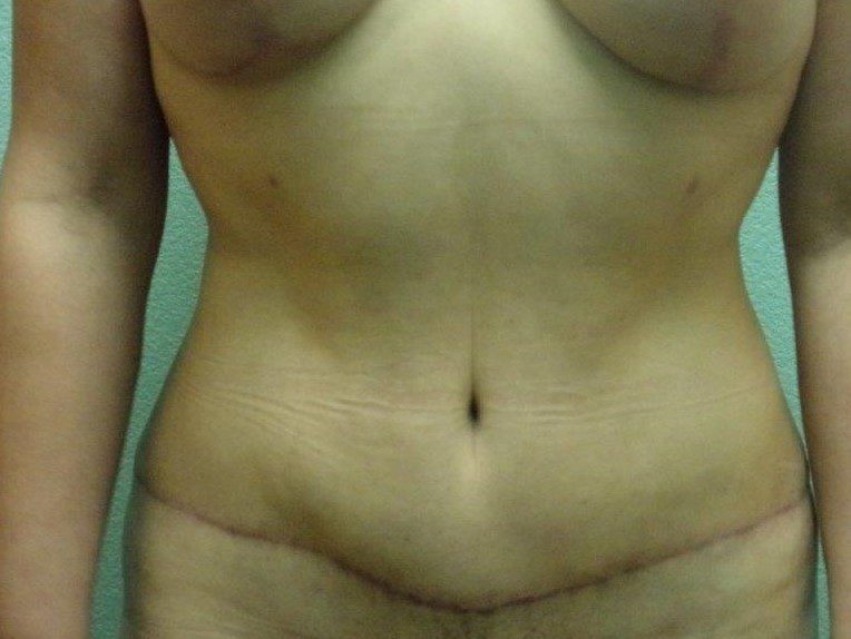 Tummy Tuck Patient Photo - Case 3606 - after view