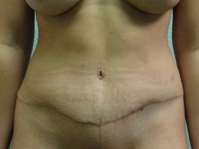 Tummy Tuck Patient Photo - Case 3613 - before view-0