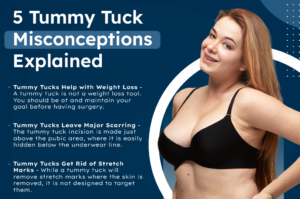 5 Tummy Tuck Misconceptions Explained thumb
