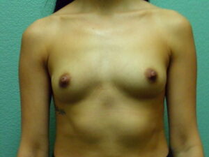 Breast Augmentation - Case 4621 - Before
