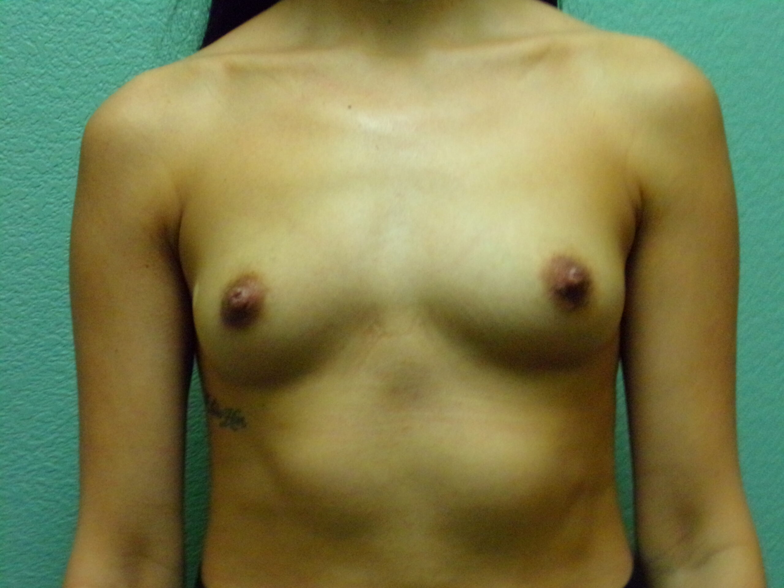 Breast Augmentation Patient Photo - Case 4621 - before view-0