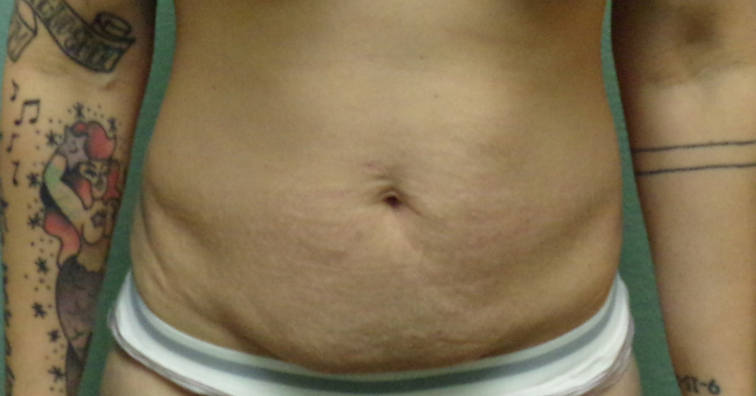 Tummy Tuck Patient Photo - Case 4625 - before view-0
