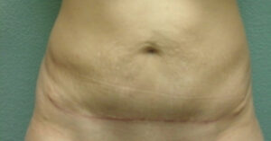 Tummy Tuck - Case 4625 - After