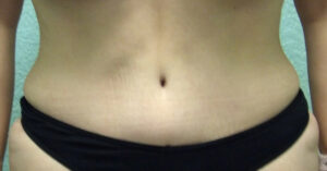 Tummy Tuck - Case 4645 - After