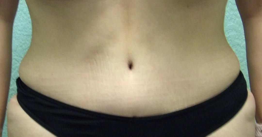 Tummy Tuck Patient Photo - Case 4645 - after view