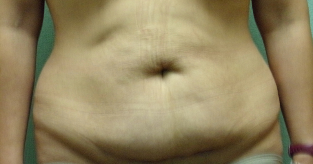 Tummy Tuck Patient Photo - Case 4645 - before view-0