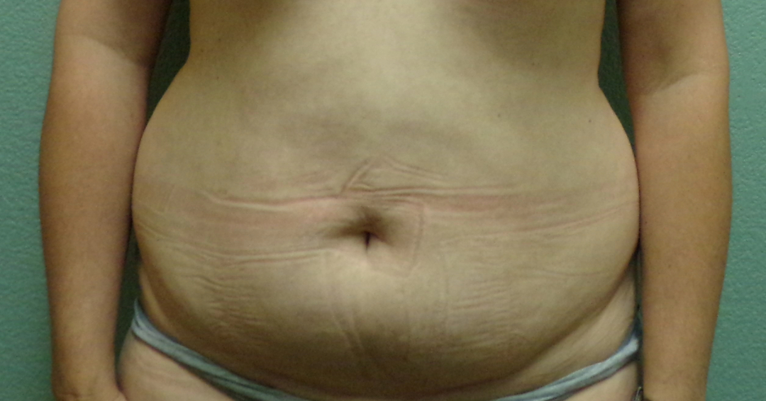 Liposuction Patient Photo - Case 4654 - before view-0