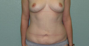 Liposuction - Case 4654 - After