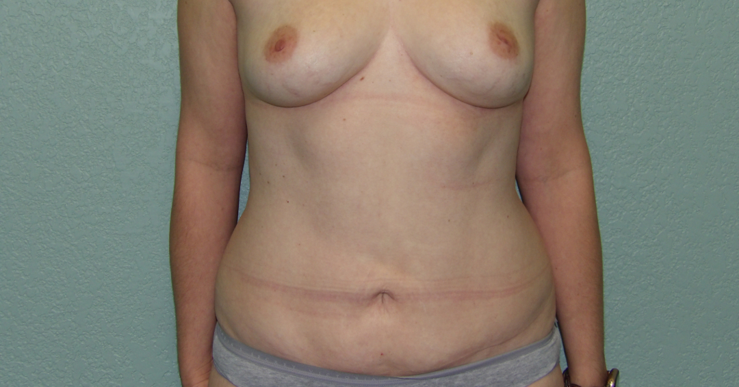 Liposuction Patient Photo - Case 4654 - after view-0