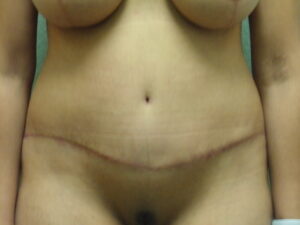 Tummy Tuck - Case 4662 - After