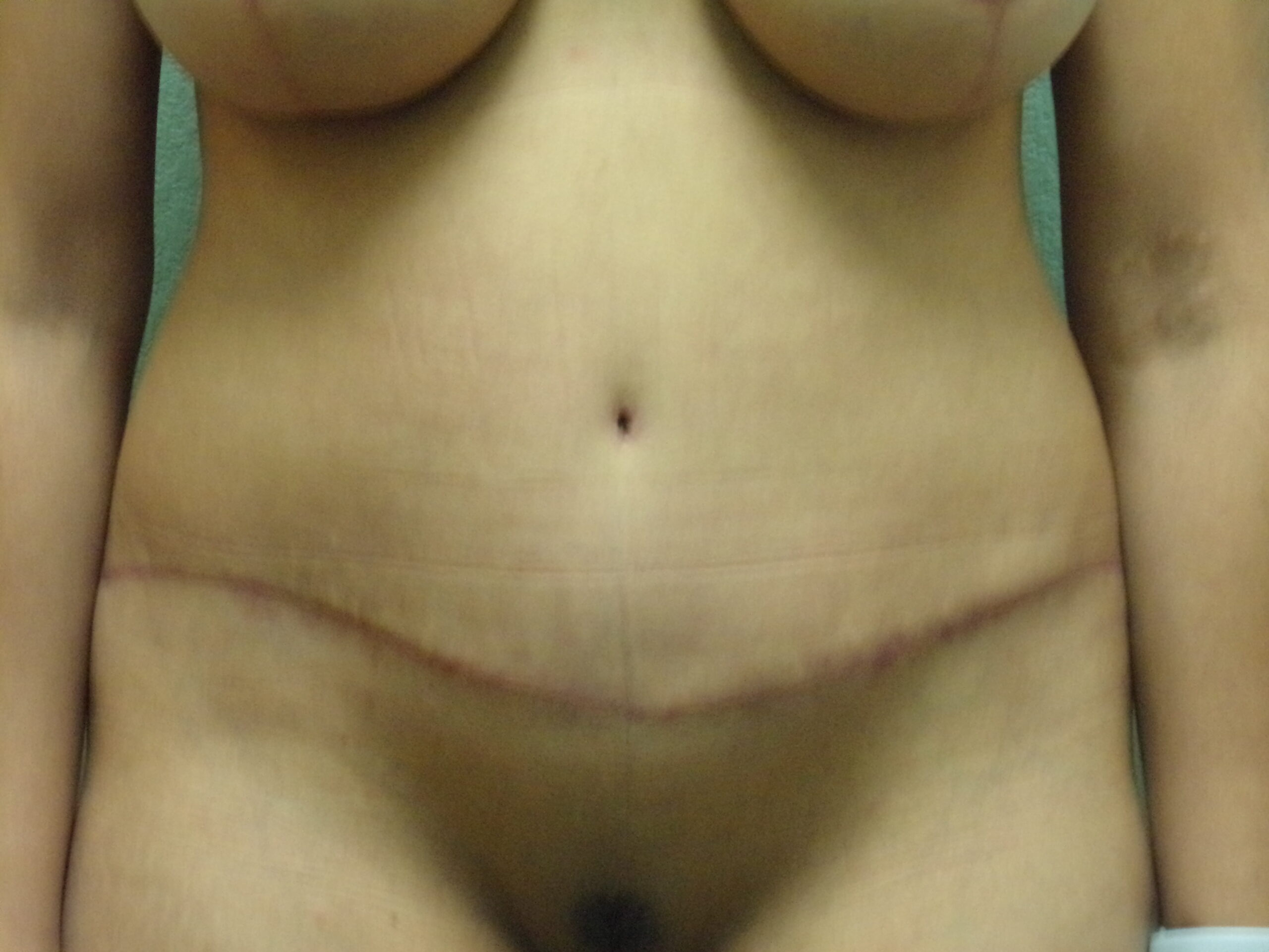 Tummy Tuck Patient Photo - Case 4662 - after view-0