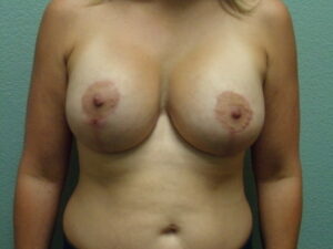 Breast Augmentation & Lift - Case 4672 - After