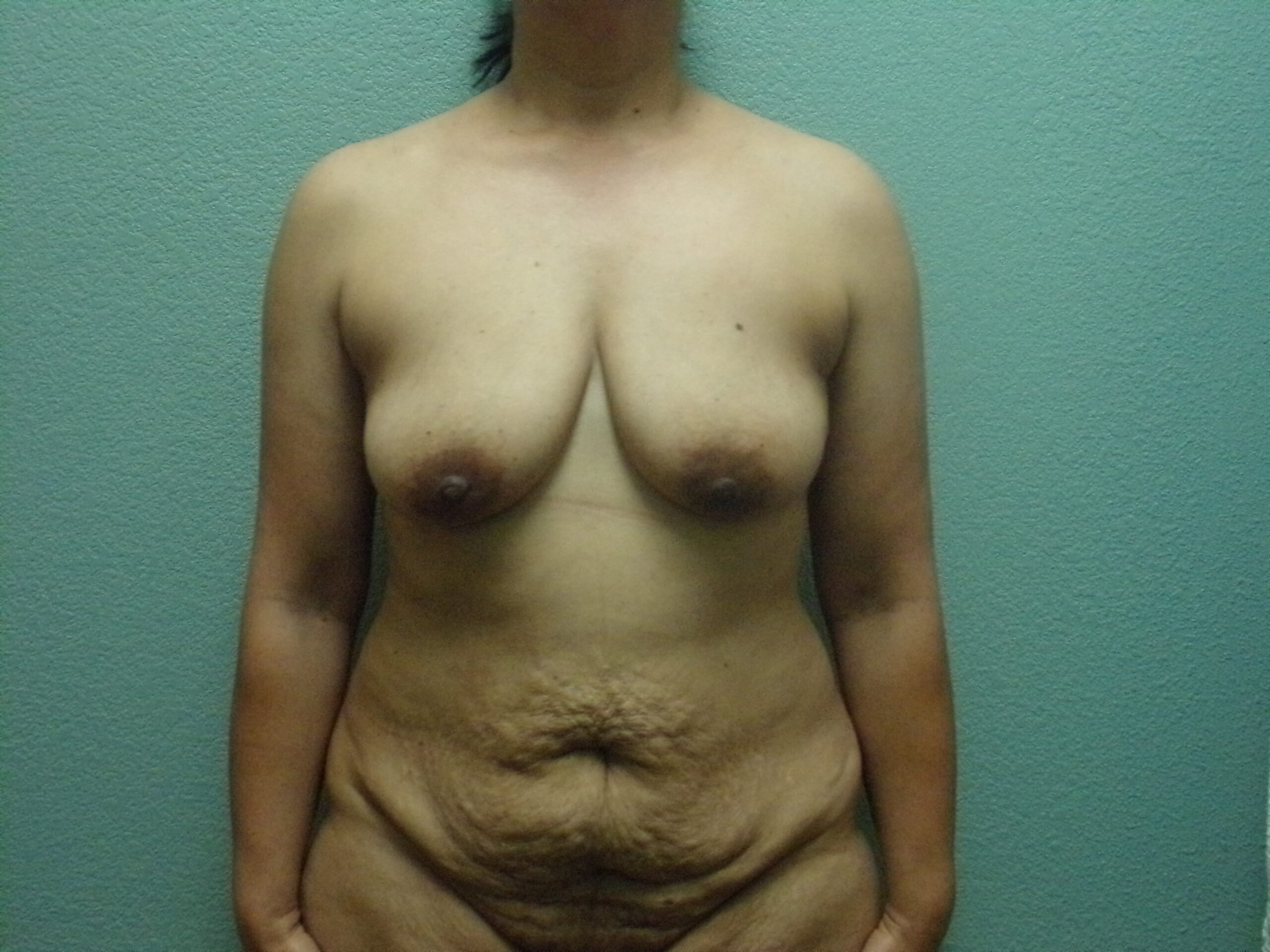 Tummy Tuck Patient Photo - Case 4677 - before view-0