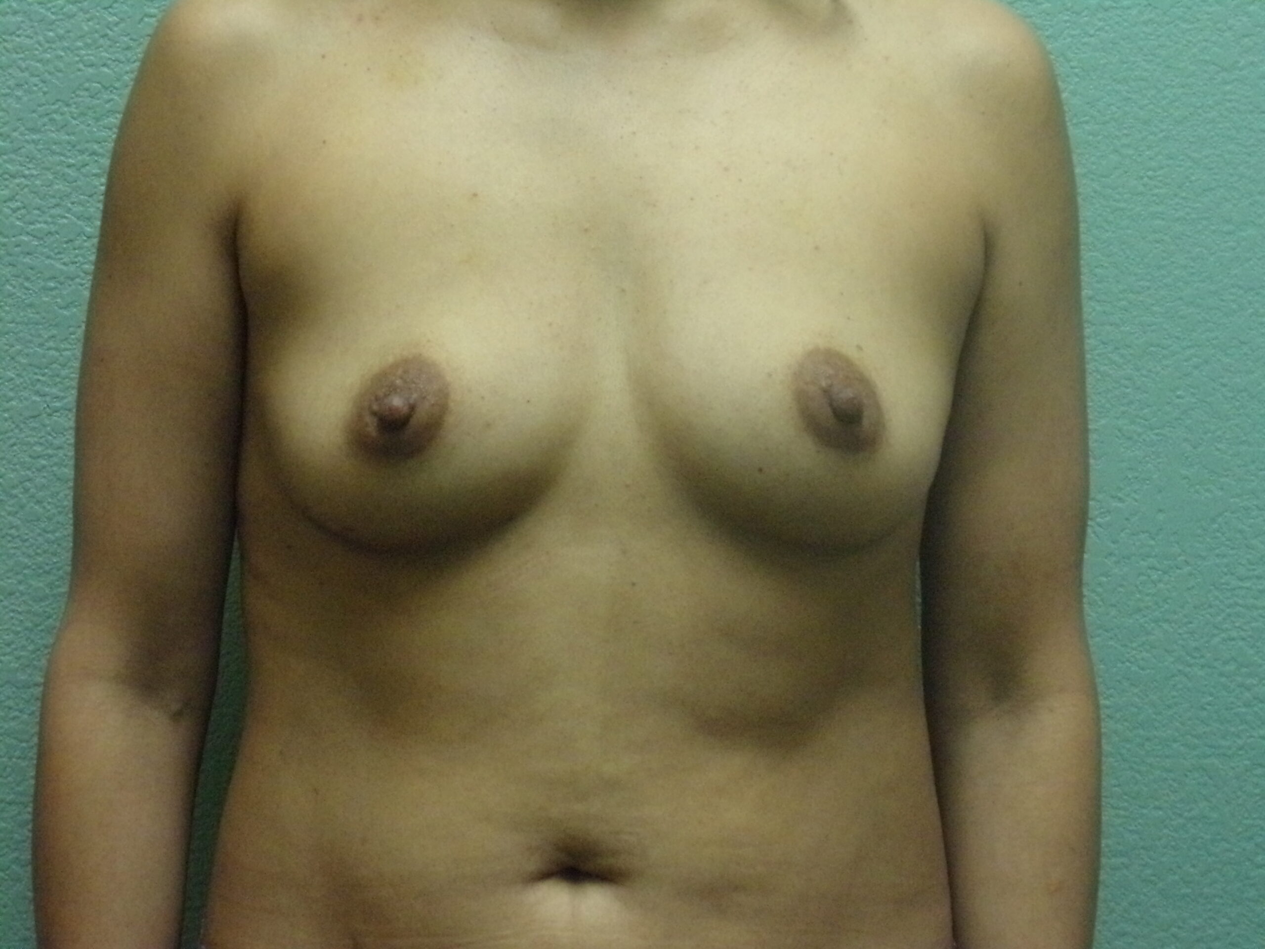 Breast Augmentation Patient Photo - Case 4682 - before view-