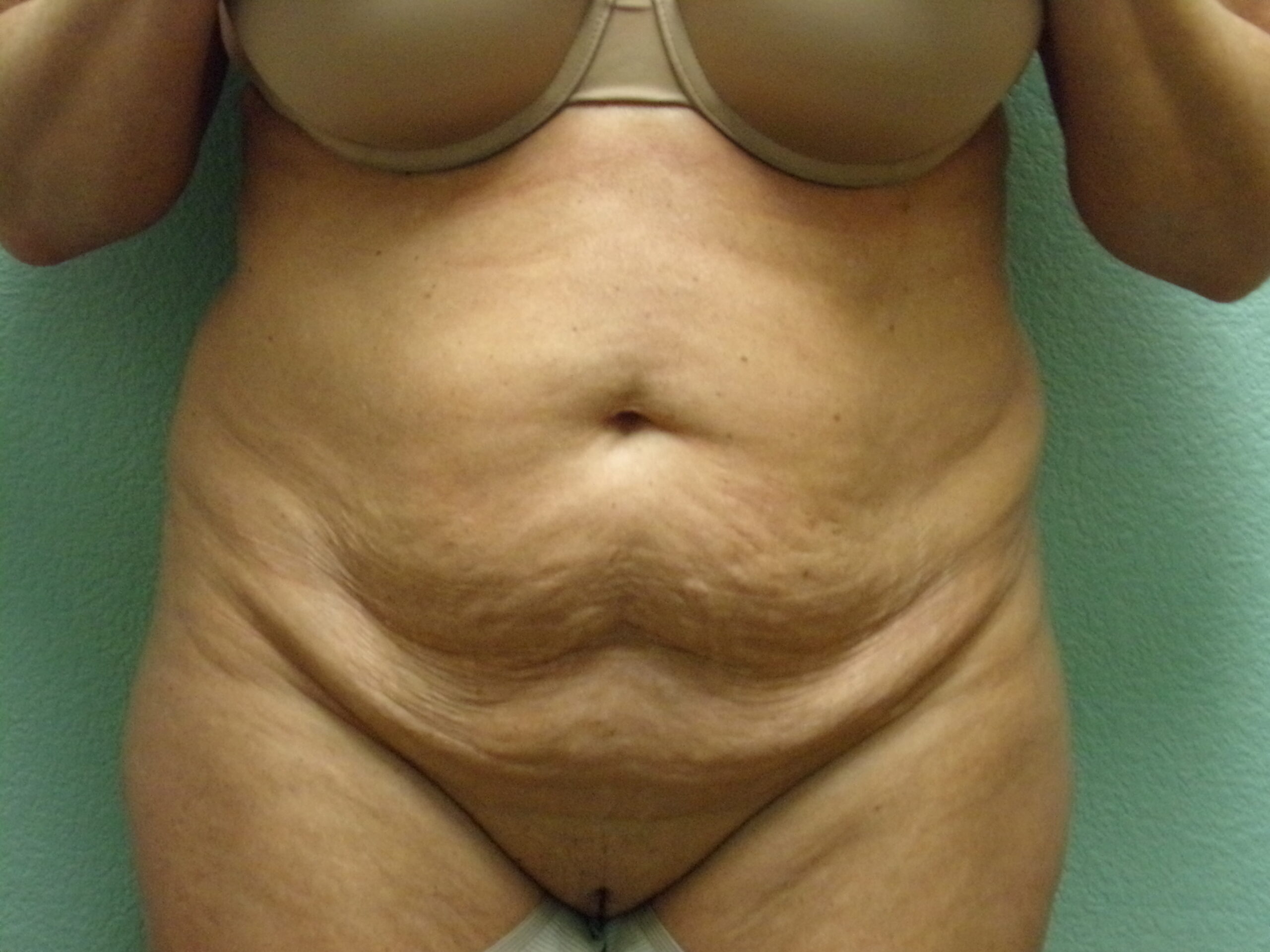 Tummy Tuck Patient Photo - Case 4687 - before view-0