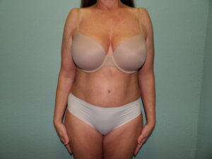 Tummy Tuck - Case 4687 - After