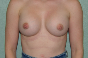 Breast Augmentation - Case 4692 - After