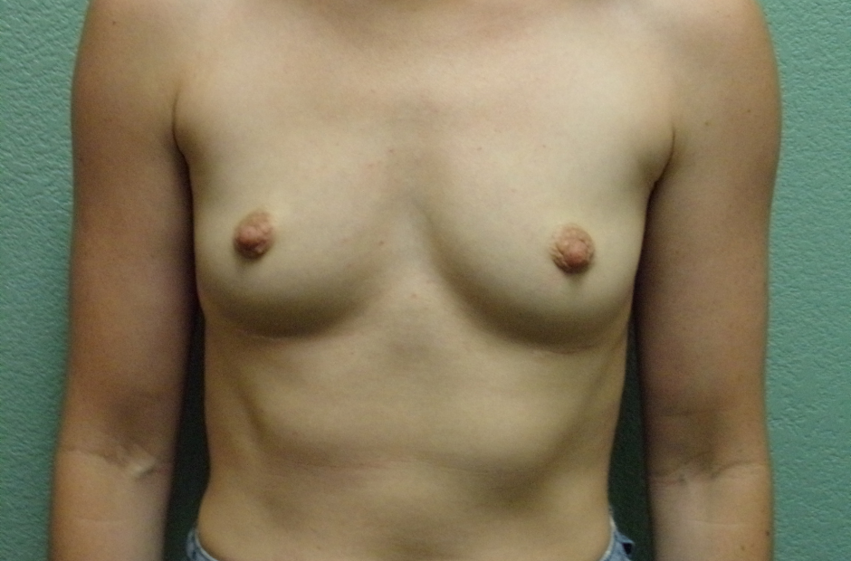 Breast Augmentation Patient Photo - Case 4692 - before view-