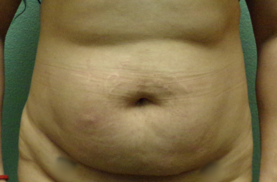 Tummy Tuck Patient Photo - Case 4697 - before view-0