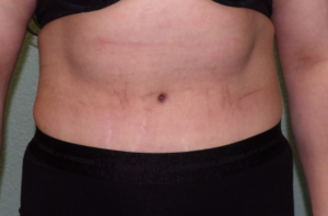 Tummy Tuck - Case 4697 - After