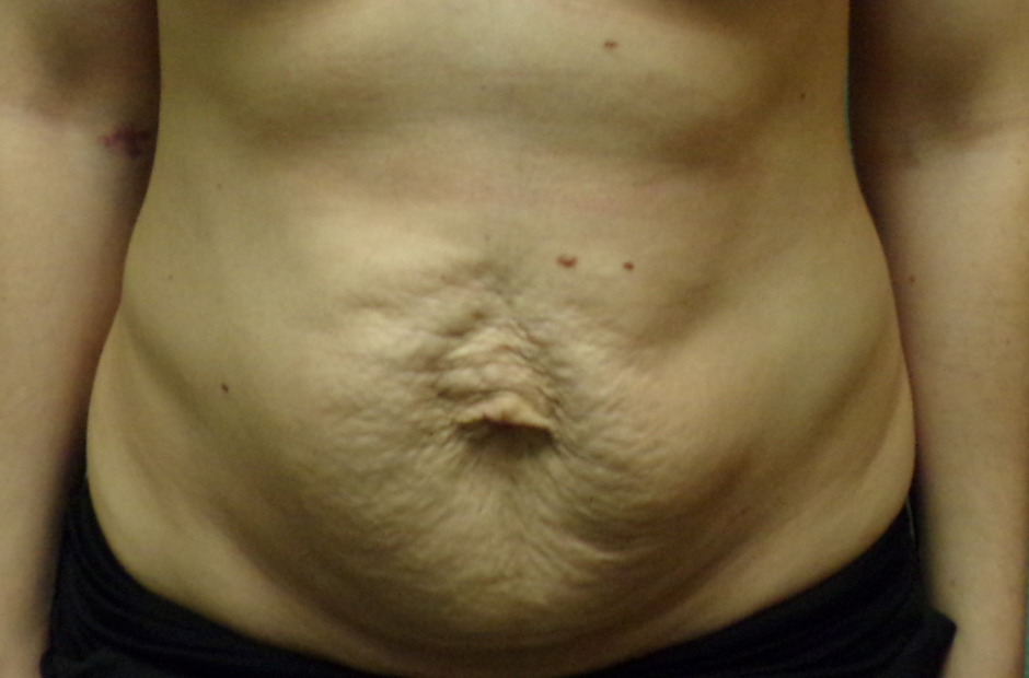 Tummy Tuck Patient Photo - Case 4702 - before view-