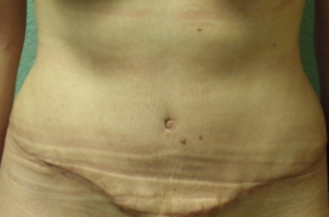 Tummy Tuck - Case 4702 - After