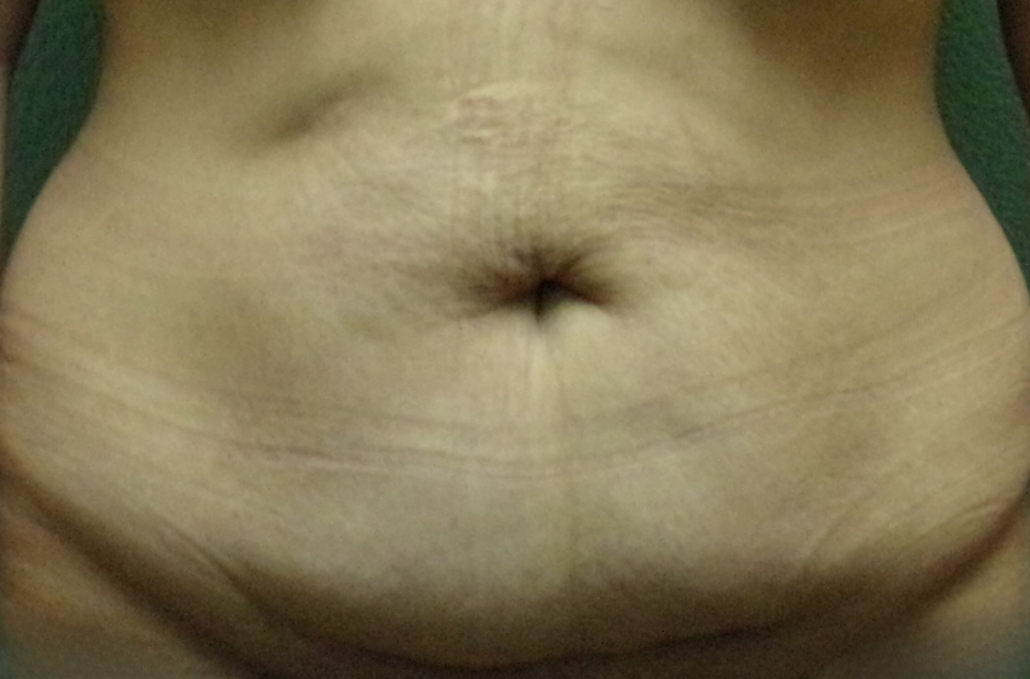 Tummy Tuck Patient Photo - Case 4706 - before view-