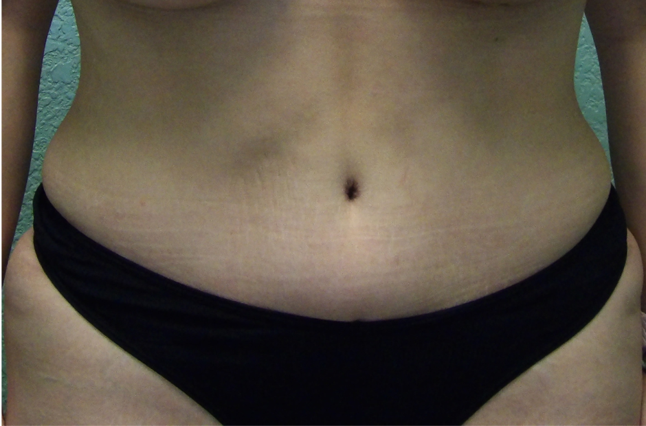Tummy Tuck Patient Photo - Case 4706 - after view