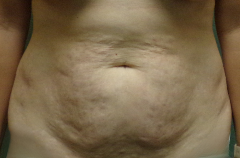 Tummy Tuck Patient Photo - Case 4711 - before view-0
