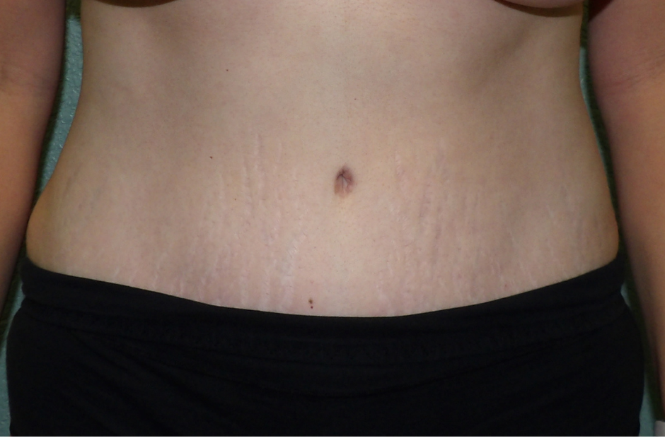 Tummy Tuck Patient Photo - Case 4711 - after view-0