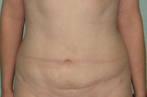 Liposuction - Case 4716 - After