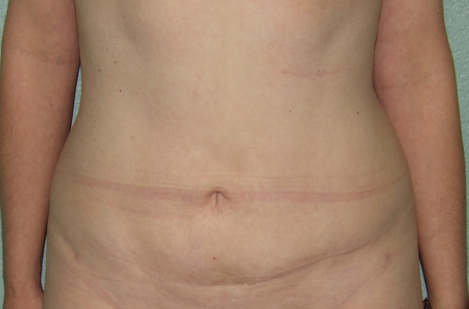 Liposuction Patient Photo - Case 4716 - after view-0