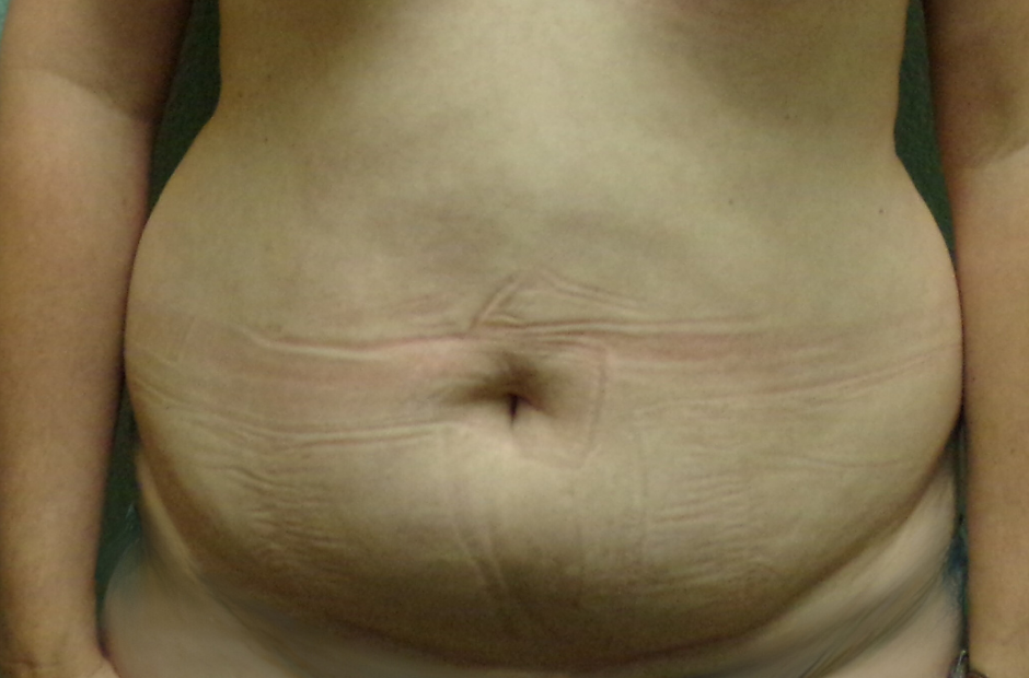 Liposuction Patient Photo - Case 4716 - before view-0