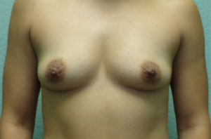 Breast Augmentation - Case 4724 - Before