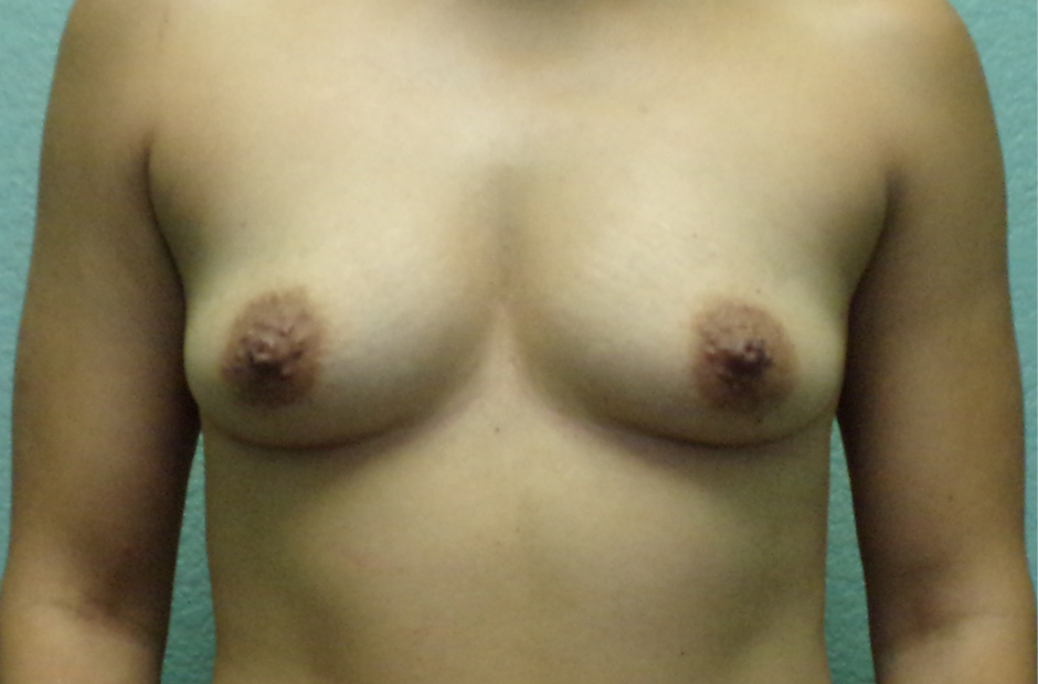 Breast Augmentation Patient Photo - Case 4724 - before view-0
