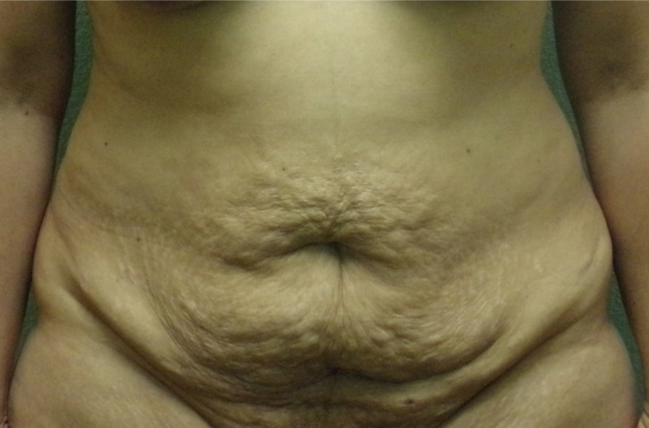Tummy Tuck Patient Photo - Case 4728 - before view-