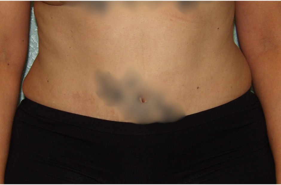 Tummy Tuck Patient Photo - Case 4728 - after view-0